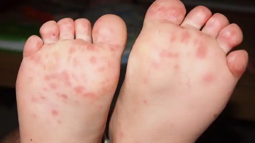 手足口病