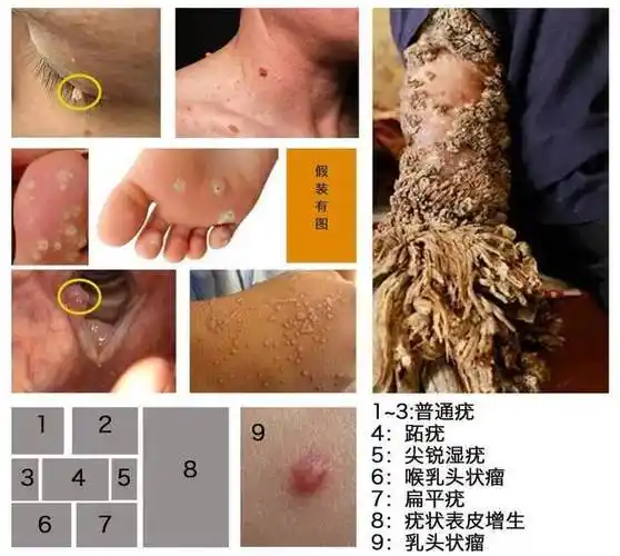 hpv引起的各种皮肤或黏膜疣状病变造成疣的hpv病毒可以通过轻微破坏