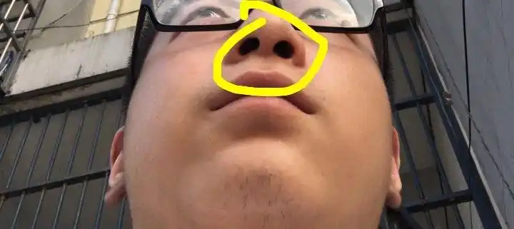 我的鼻子和上唇人中部位不对称 鼻子有很大的问题 然后人中部位