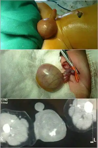 畸胎瘤妇产医院手术要排很久,b超报告还没出来,求大