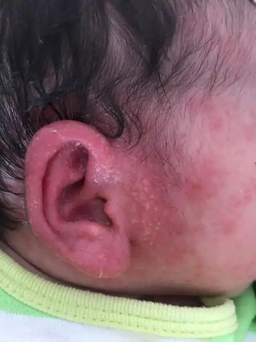 新生儿耳朵发红还起皮这是怎么回事?