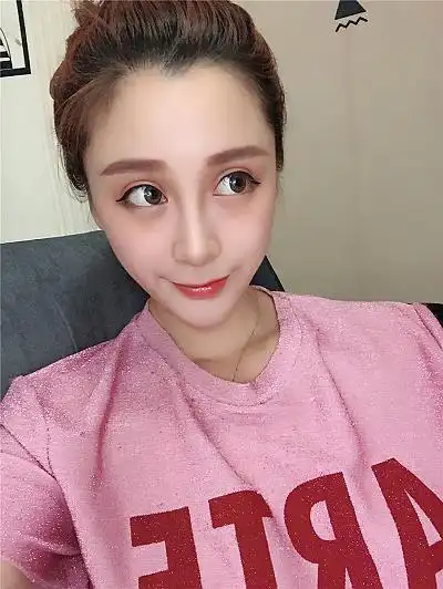 芭比双眼皮术后分享