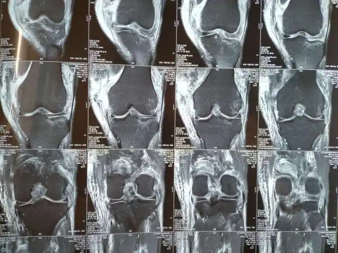 膝关节前后交叉韧带内侧副韧带断裂关节镜治疗