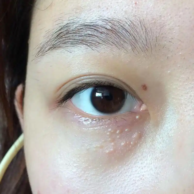 脸上经常长脂肪粒?