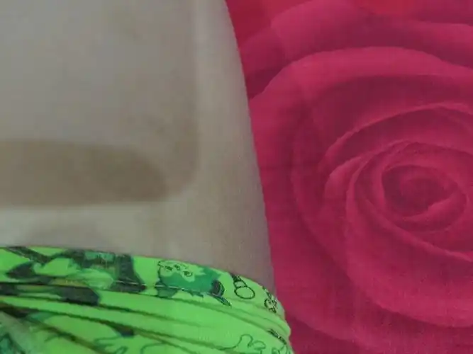 男孩11岁,屁股上长的这个斑,小时候几个月的时候发现只有一点点大