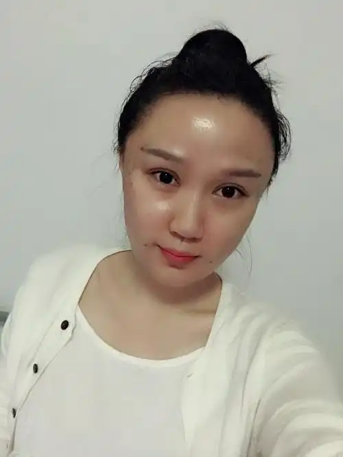 全脸脂肪填充多少钱(脂肪填充全脸部多少钱左右)