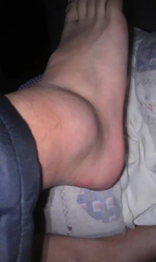 打篮球时脚不小心扭伤 肿了起来还 能动动 我该怎么办?