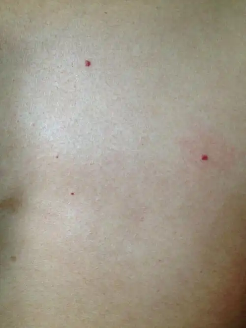 身上长小红点是怎么回事(附图)~求解