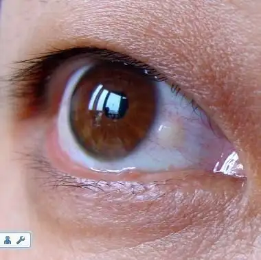 我的眼睛里长了个水泡样黄白色物体,有点痒,谁能告诉我这是什么病