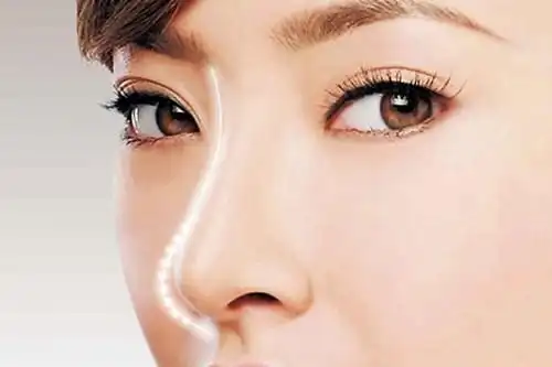 鼻翼上提手术,是鼻子整形手术的一类,对于鼻子凹陷坍塌的患者来说