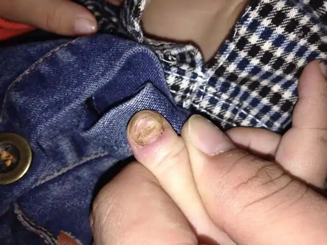 儿子两岁,半年前手指甲变成了这样,怎么复原?