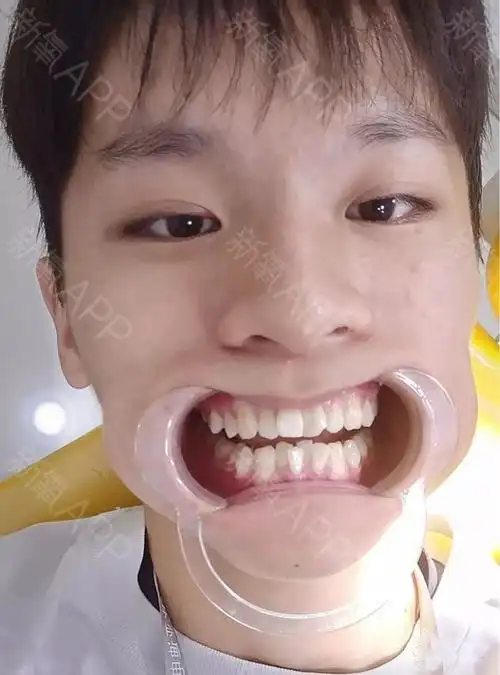 矫正牙齿是我做过最_圈子-新氧美容整形
