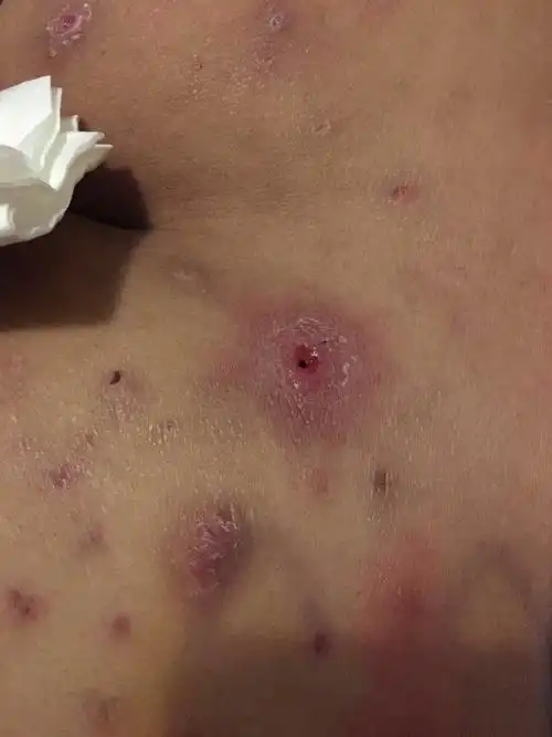 屁股长了好多年的痘痘是毛囊炎吗._百度知道