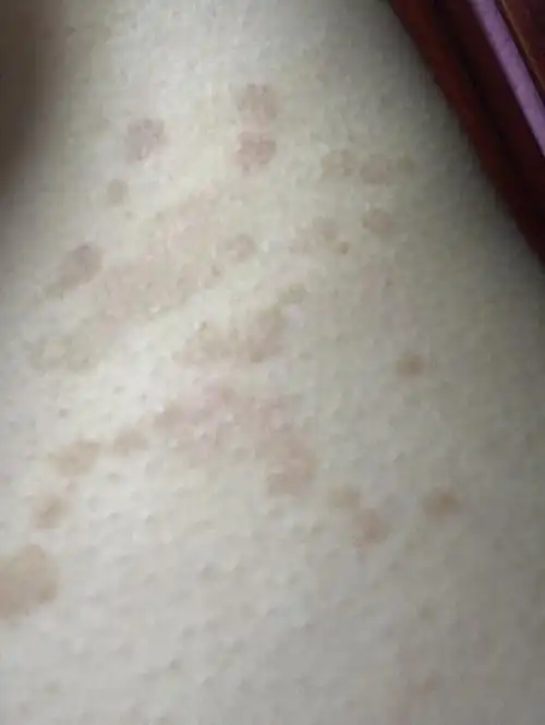 身上突然发斑 是体内有什么病变?