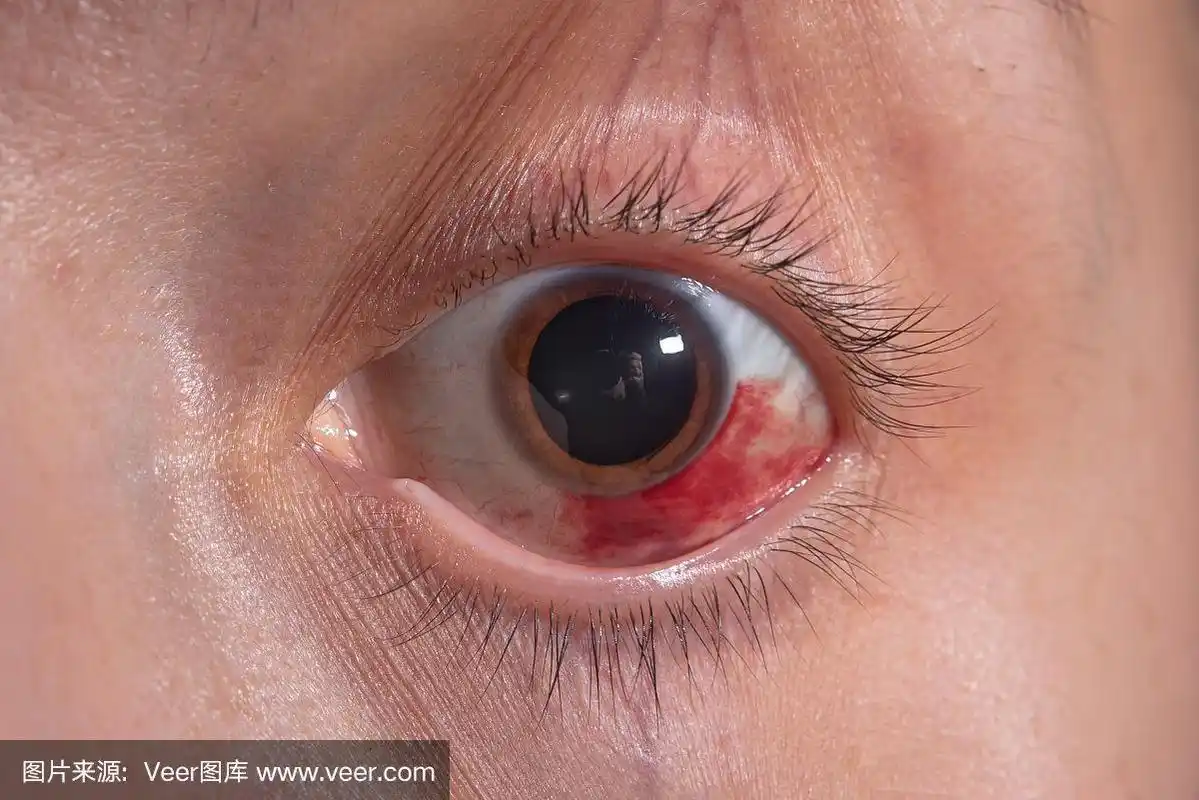 一个女孩眼睛出血.角膜的磨损.宏.