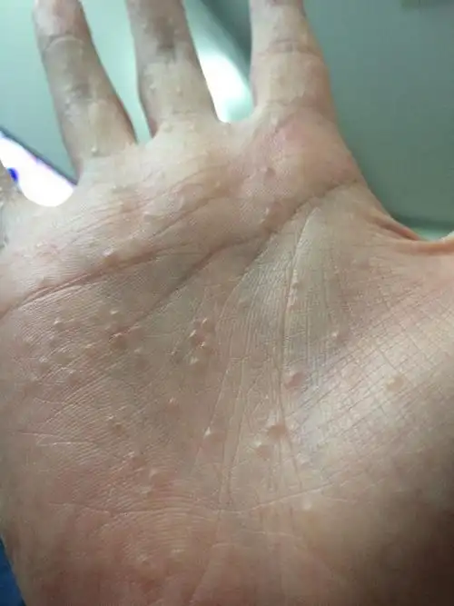 手心长了好多小水泡 很痒 怎么办