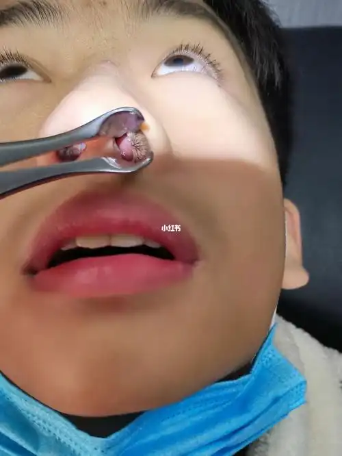 严重鼻甲肥大过敏性鼻炎