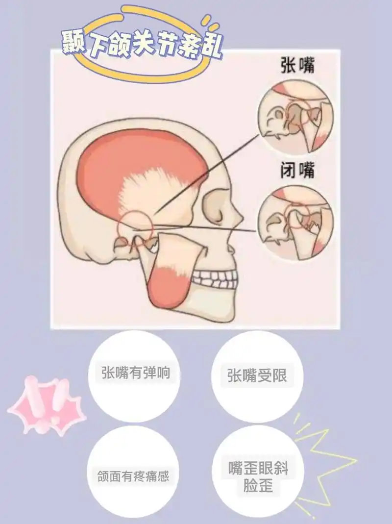 颞下颌关节紊乱的一些科普.