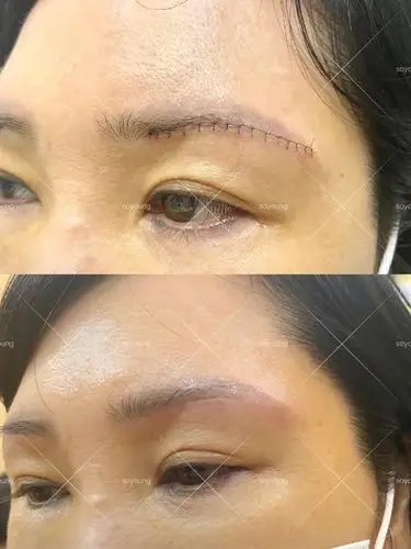 切眉术第七天的效果