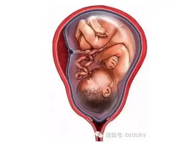 医生会根据不同情况采取不同措施,如输液,羊膜腔穿刺注入生理盐水等