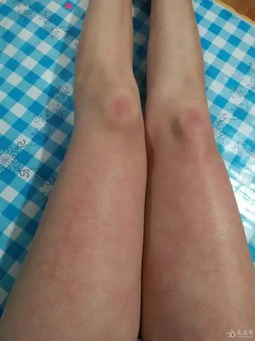 双大腿前侧皮肤瘀斑3个月请各位老师帮忙看看送花送花