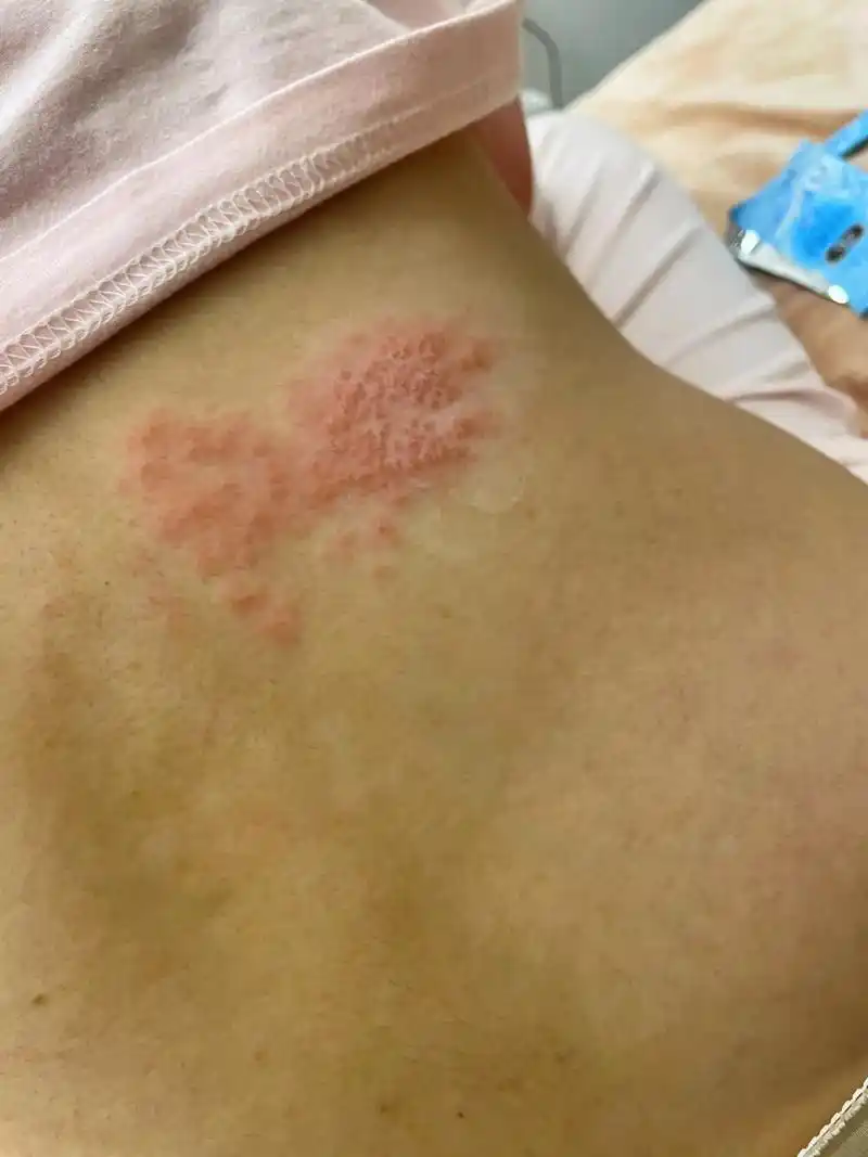 带状疱疹第五天了 还在出泡 睡觉都会被疼醒的那种