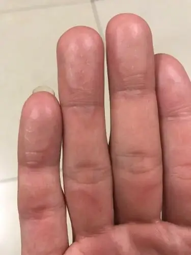 游泳后手指肚水肿,好几天不消,不知道这是什么原因,需要用药吗?