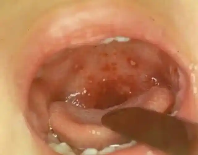 【家园共育】:高度警惕夏季高发病—疱疹性咽颊炎!