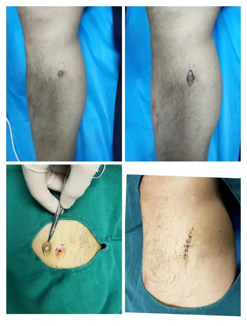 皮肤纤维瘤切除术2.色素痣切除术3.痤疮瘢痕切除术 - 抖音