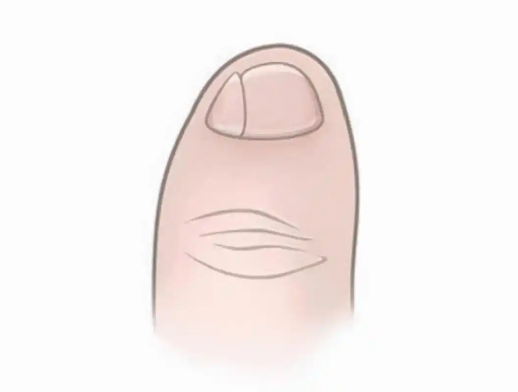 那些小脚趾指甲分成两瓣的人,到底是什么来历?你的指甲是这样吗