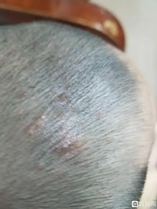 宝宝头上老喜欢长疮说是热毒