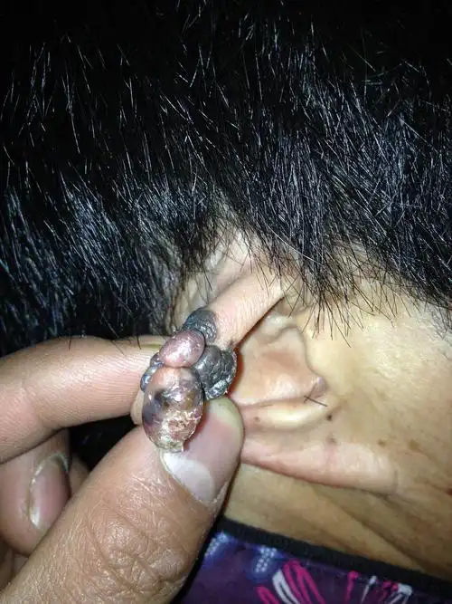 我母亲的耳朵上长的肉瘤 请大家帮看看这是什么 怎么治 多谢了