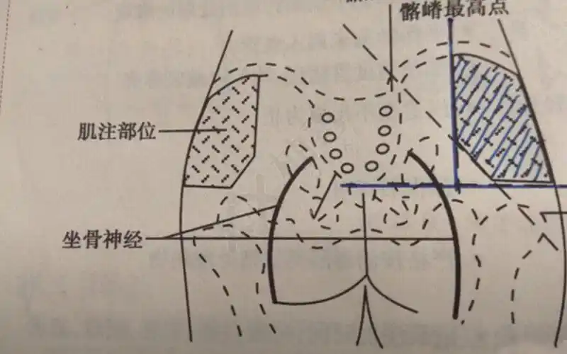而该药物的注射方法只有一种,就是肌肉注射,大家可以注射到臀大肌或者