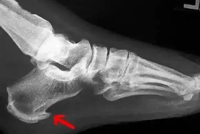 脚后跟疼是病吗如何治