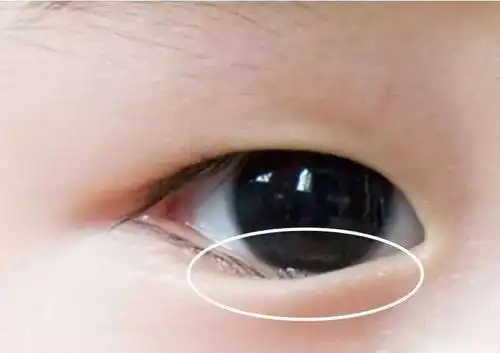 两岁小孩倒睫毛怎么办