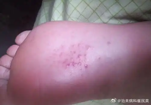 中医##皮肤病##微博健康公开课