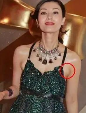 副乳才是真的毁身材 副乳怎么消除?