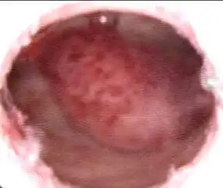 宫颈息肉摘除术比较简单,碘伏消毒阴道,宫颈后,用止血钳夹住息肉蒂