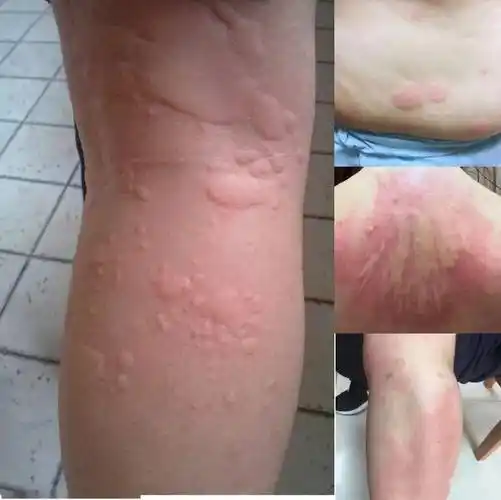 什么是荨麻疹?_治疗_药房_症状