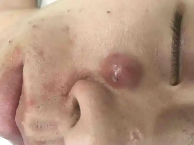 囊肿型痤疮的治疗(一)