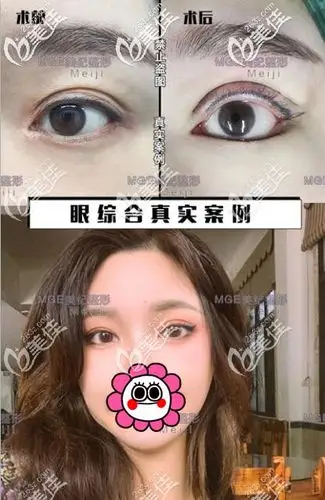 好医生都不建议开眼角但千万不要眼综合的说法这几组案例用术后对比照