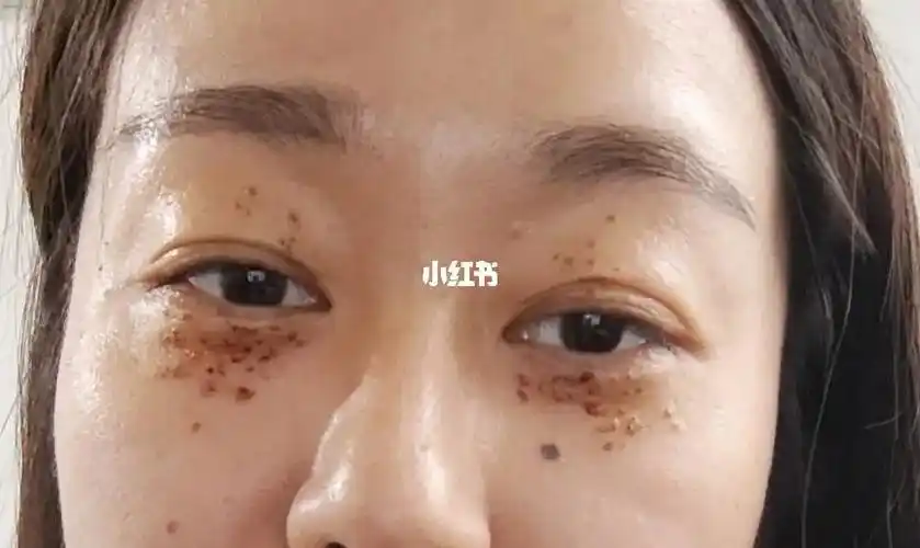 激光汗管瘤第三天