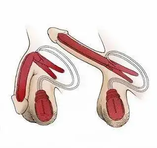 阴茎弯曲:好好的"枪"歪了还有用吗?