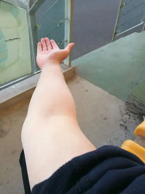 右上臂肱骨骨折过,有点外翻,可否考公务员警察(国考上海出入境边防