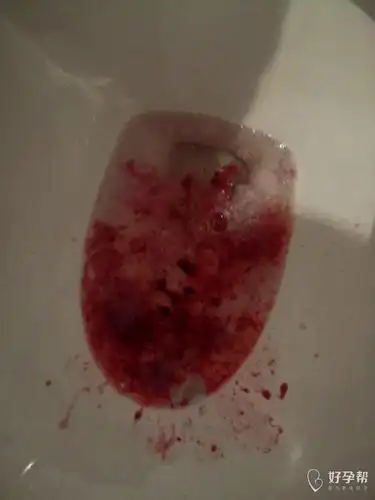 孕吐真难受不知道的以为吐血了呢