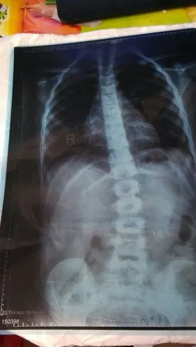 女儿8岁,在医院照x光片,发现胸腰段脊椎略侧突畸形,严重吗?