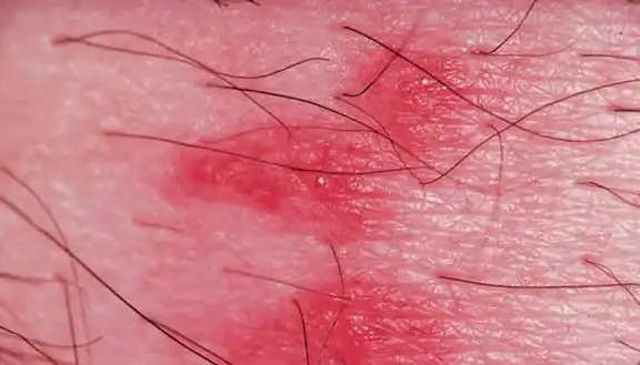 丘疹性荨麻疹怎么解决?这些方法帮助你快速清除症状