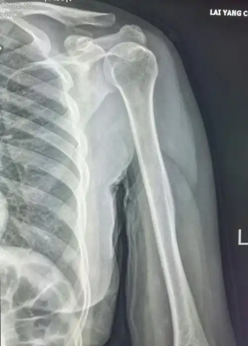 写美篇这个病例提醒我们,肩部背部外伤要注意肩胛骨,肩关节正位不宜