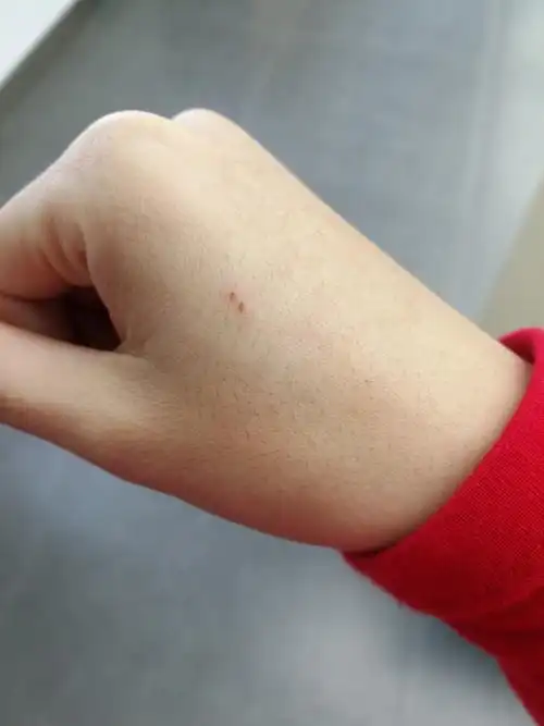 这是不是老鼠咬的啊,还是无意擦伤的,我没注意看过