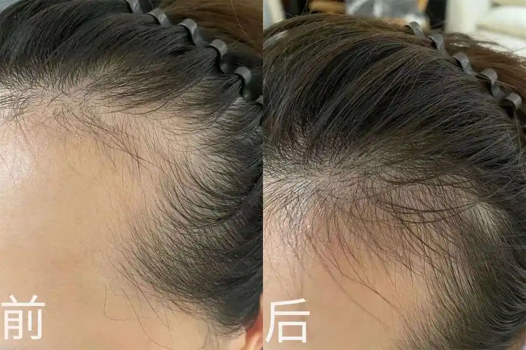 脱发秃头有效的防脱生发经验分享